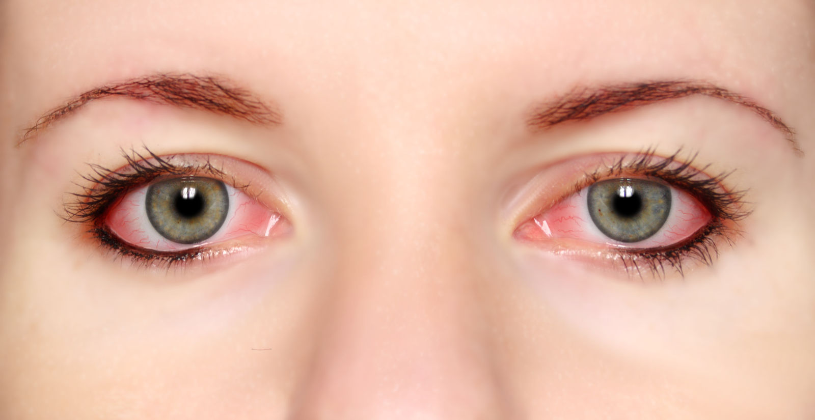 conjuntivitis-sintomas-causas-prevencion-tratamiento-oftalmolima