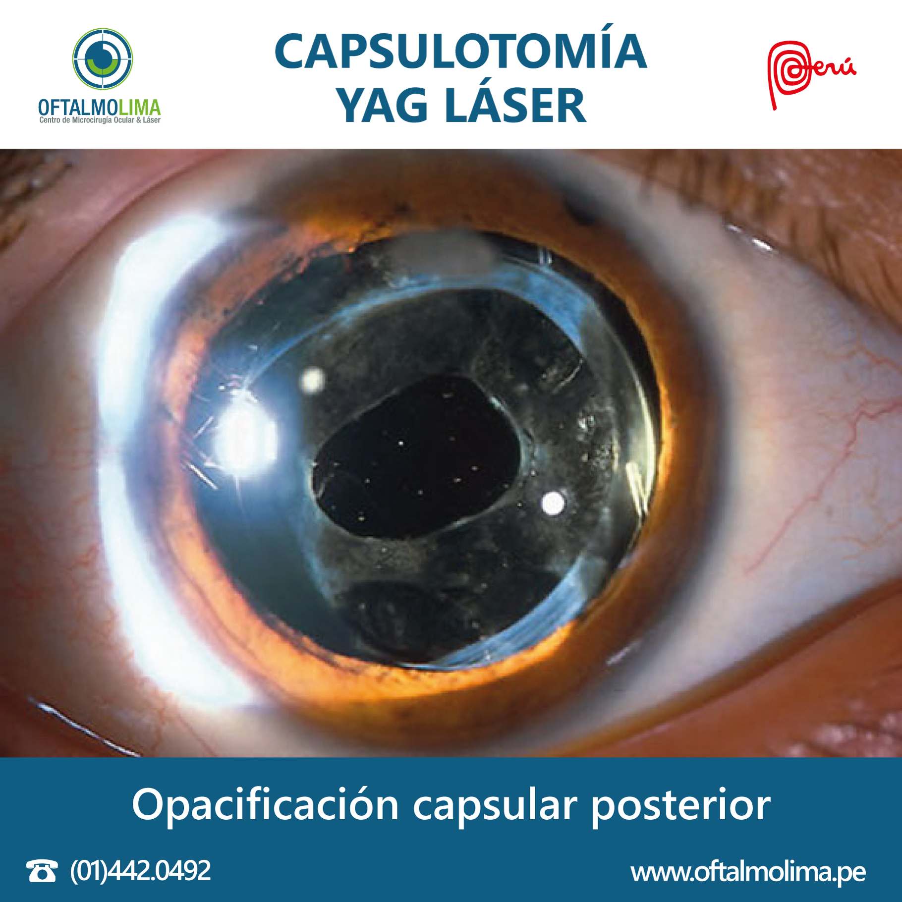 Баня после катаракты. Yag лазерная дисцизия вторичной катаракты. Лазерная капсулотомия. Yag лазерная капсулотомия.