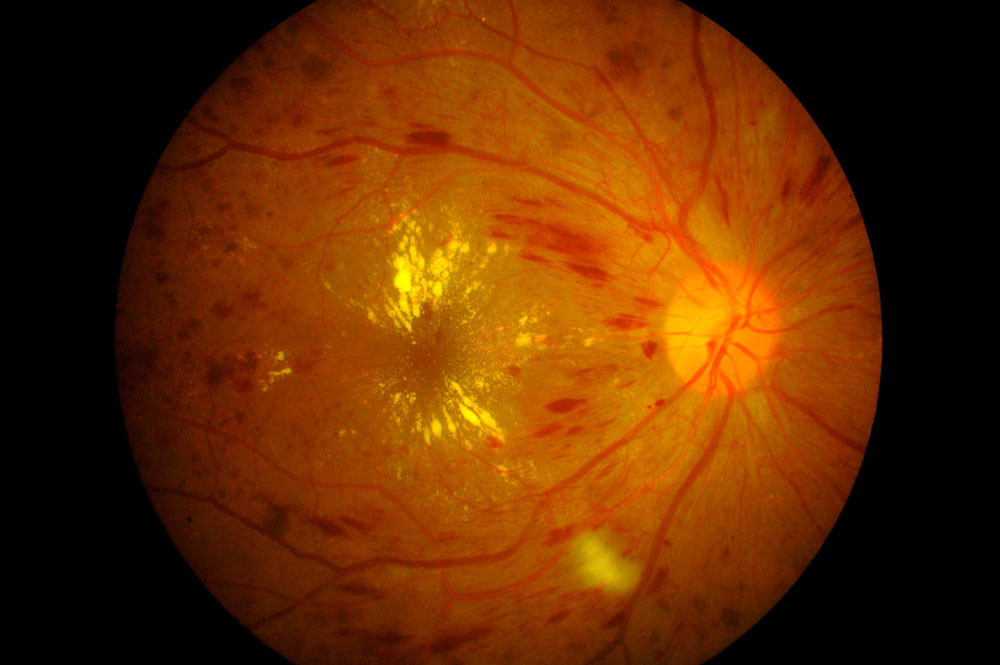 Edema Macular