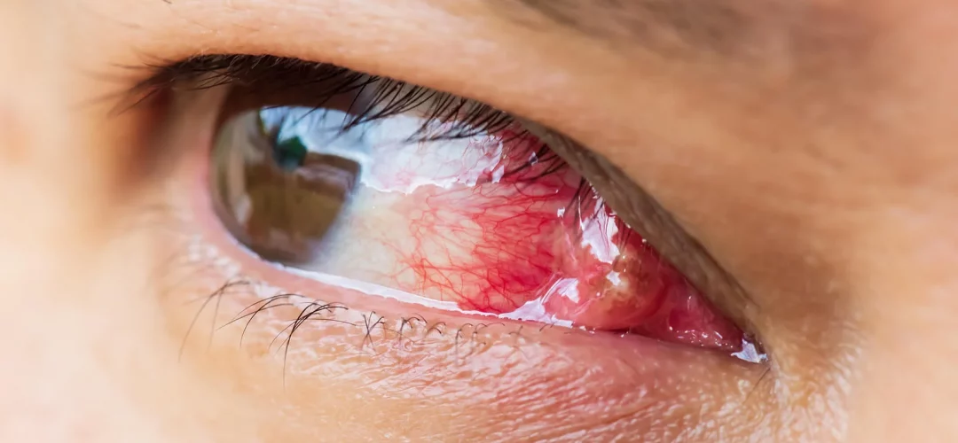 carnosidad-ojo-pterigion-oftalmolima