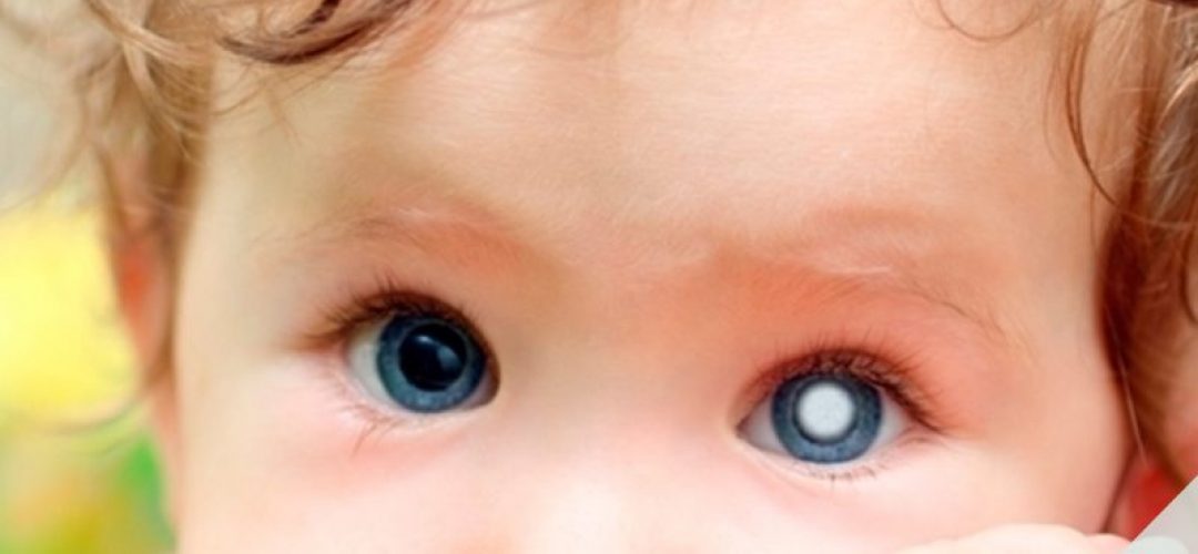 catarata-infantil-causas-sintomas-tratamiento-y-cirugia-oftalmolima