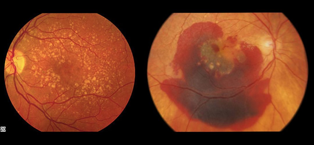 degeneracion-macular-relacionada-con-la-edad-DMRE-oftalmolima