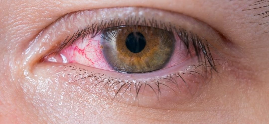 enfermedades-de-la-cornea-oftalmolima