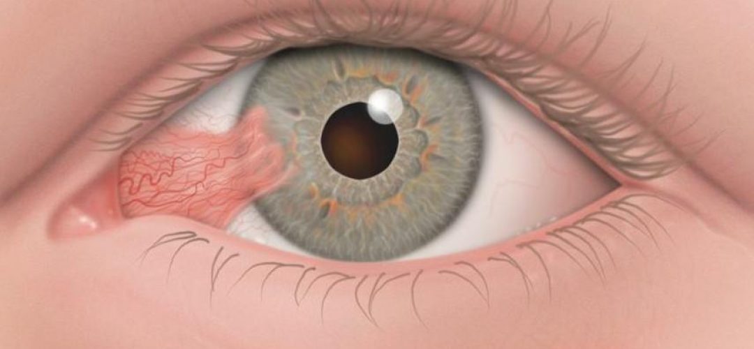 pterigion-causas-sintomas-y-tratamientos-oftalmolima