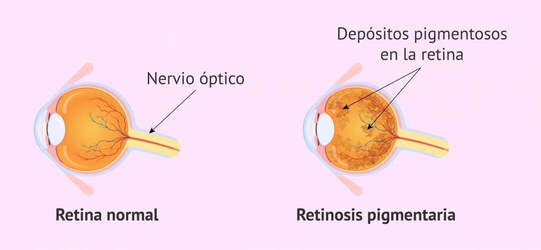 retinitis-pigmentaria-causas-sintomas-diagnostico-y-tratamiento-oftalmolima