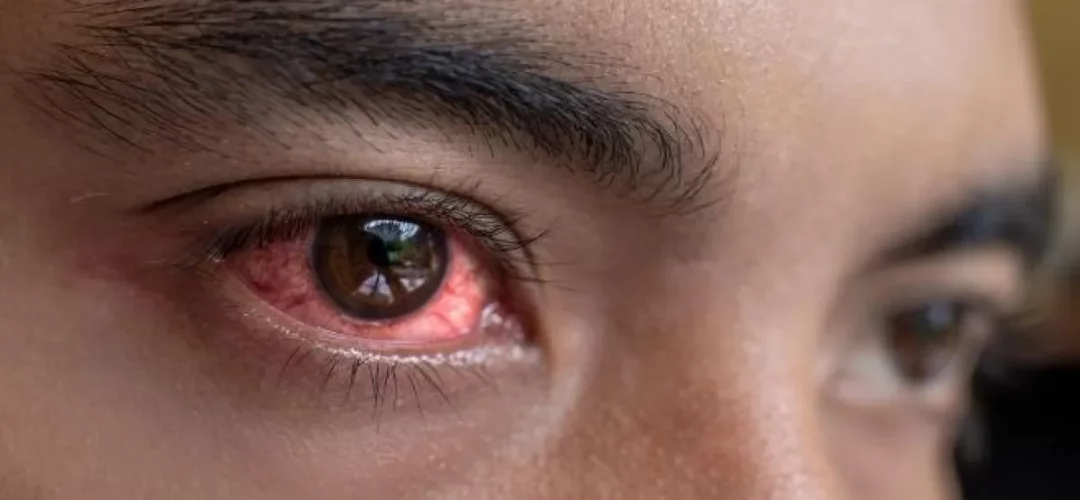 tracoma-principal-causante-de-ceguera-a-nivel-mundial-oftalmolima