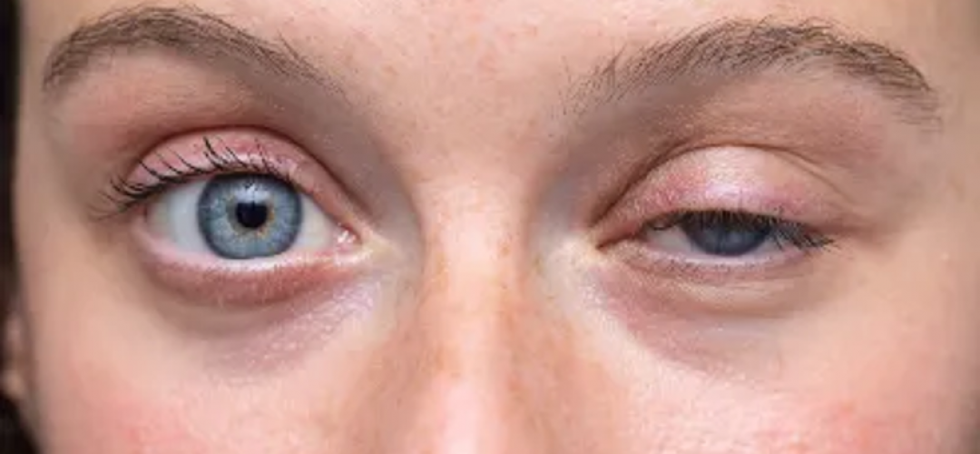tumores-oculares-palpebrales-y-orbitrarios