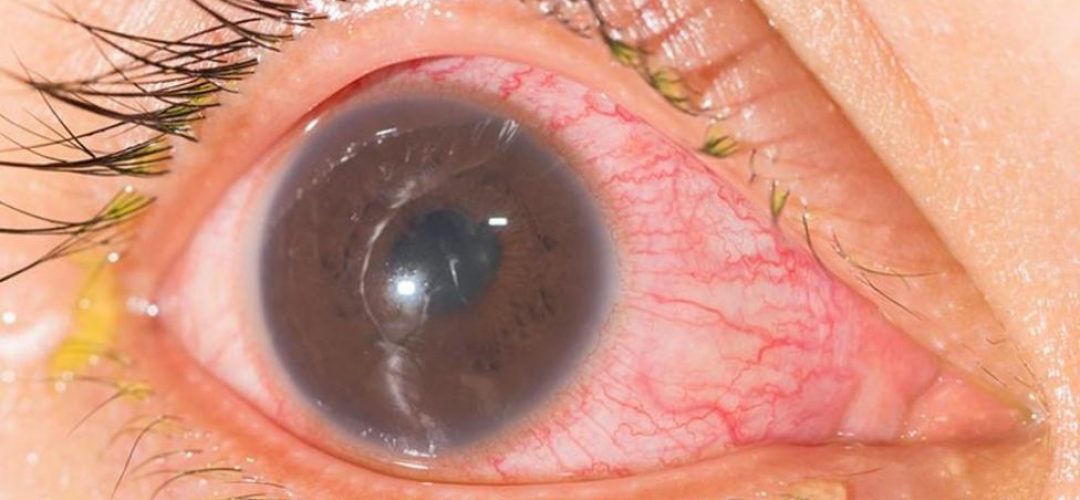 uveitis-tipos-causas-sintomas-tratamiento-oftalmolima
